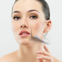 Akné v meste: prečo sú slnko, stres a znečistenie nepriateľom Vašej krásy