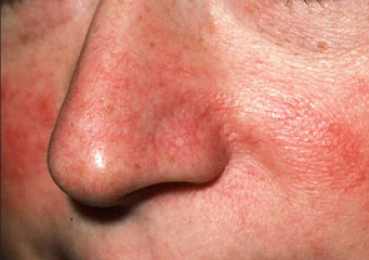 ROSACEA a ako s ňou bojovať